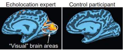 Diagram of a human brain highlighting the visual areas of the brain