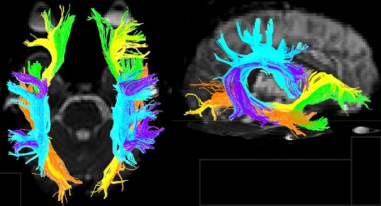 Image of brain with white matter represented by streaks of color