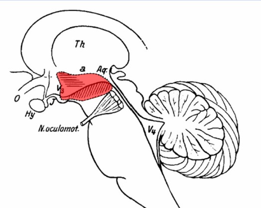 Diagram of the impacted area in people in encephalitis lethargica