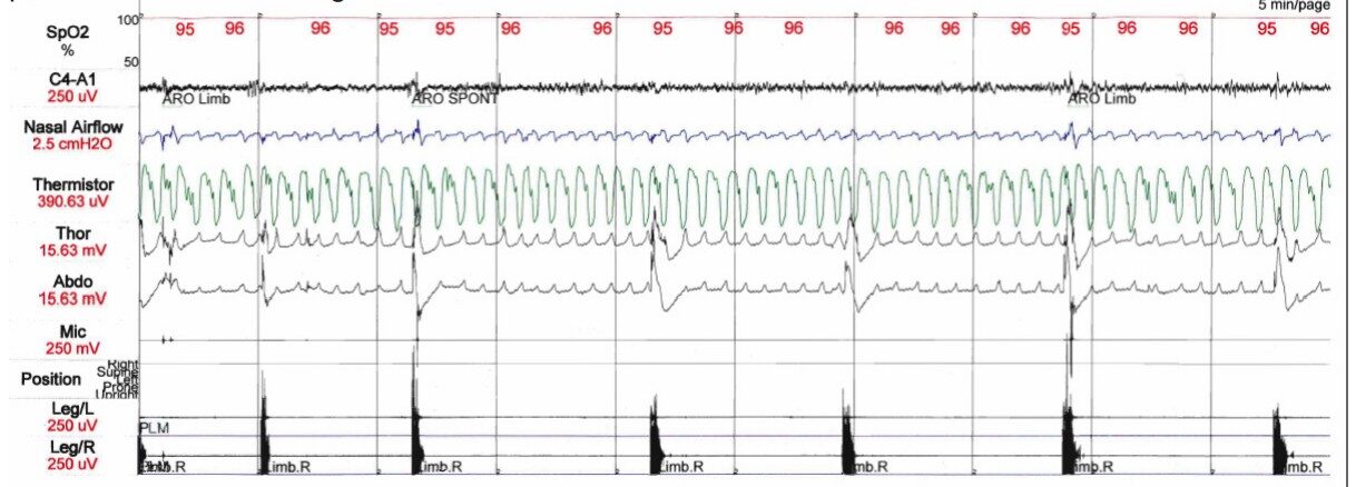 Polysomnogram result graph