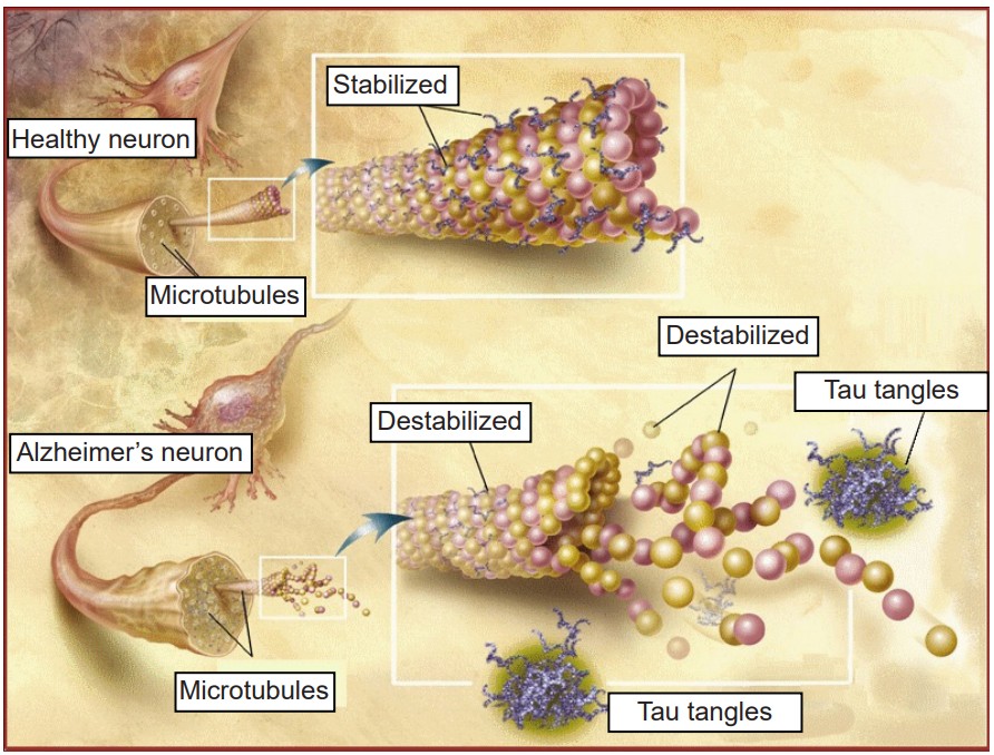 visualization showing the difference in the stabilization of microtubules in a healthy neuron versus an Alzheimer's neuron. Tau proteins become tangled, leading to destabilization