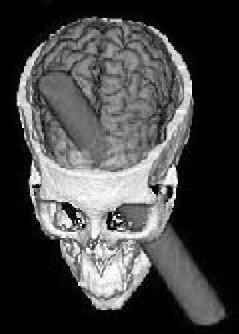 An image demonstrating Phineas Gage's skull and the rod that pierced it