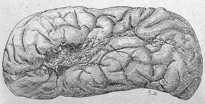 Image of a brain with language disorder aphasia